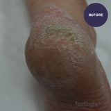 Footlogix Callus Softener 180ml