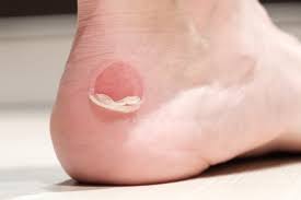 Blisters