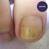 Footlogix Nail Tincture